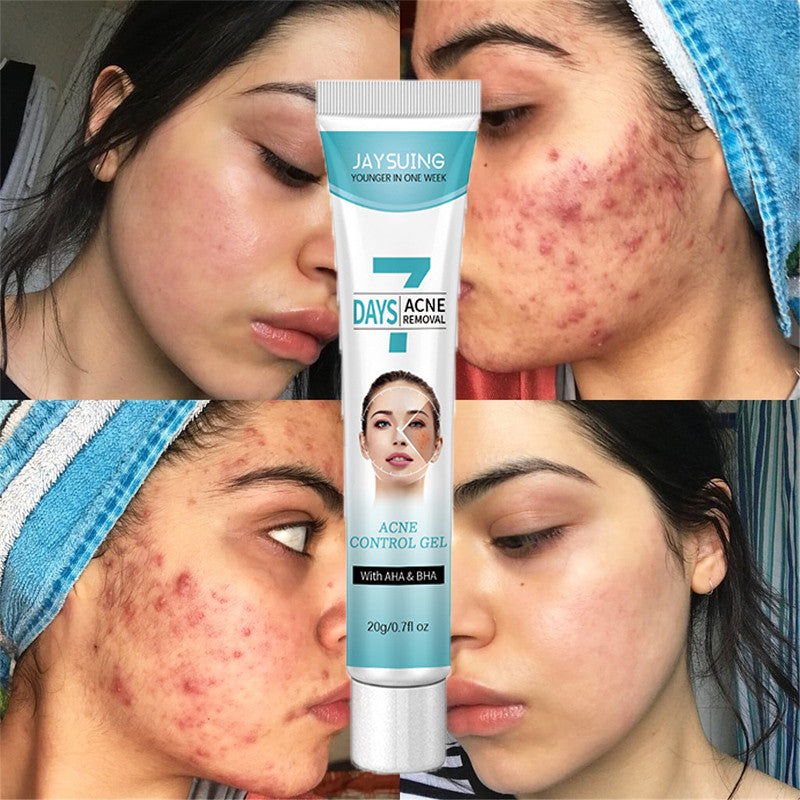 Crema facial SIN acné: !Piel limpia y suave!