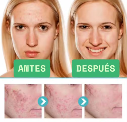 Crema facial SIN acné: !Piel limpia y suave!