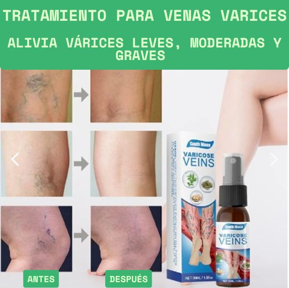 Spray para venas varices: Piernas libres, ligeras y hermosas.