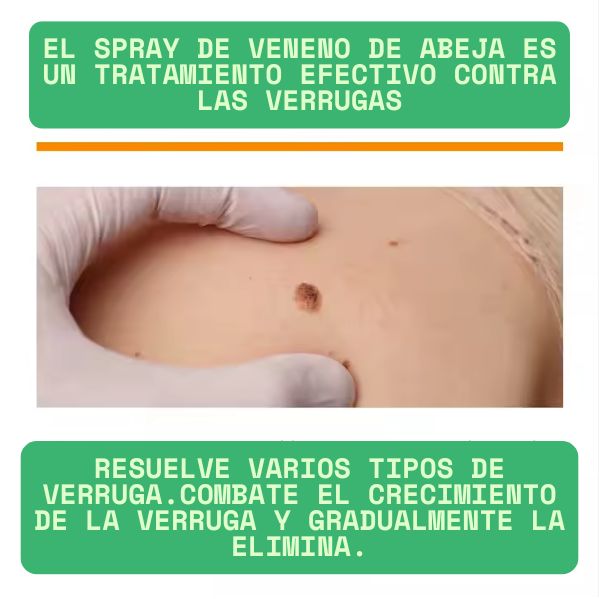 🛑 ¿Verrugas incómodas? El veneno de abeja las elimina sin dolor