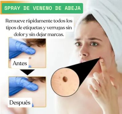 🛑 ¿Verrugas incómodas? El veneno de abeja las elimina sin dolor