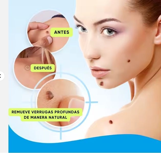 ✅ 🔥 Crema Serum Removedora: Adiós verrugas sin dolor ni cicatrices.